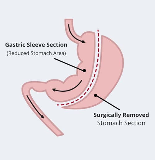 Gastric Sleeve Section