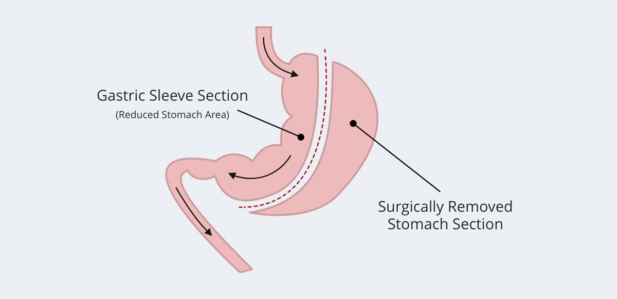 Gastric Sleeve Section