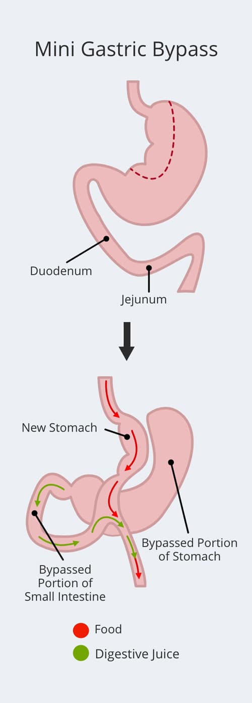 Mini Gastric Bypass