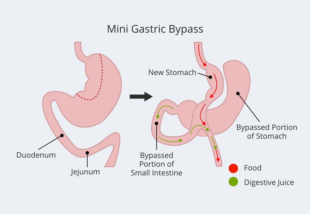 Mini Gastric Bypass