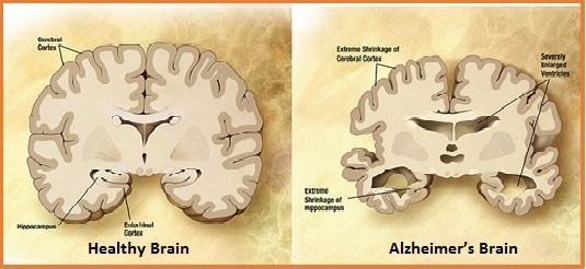 alzheimers-brain