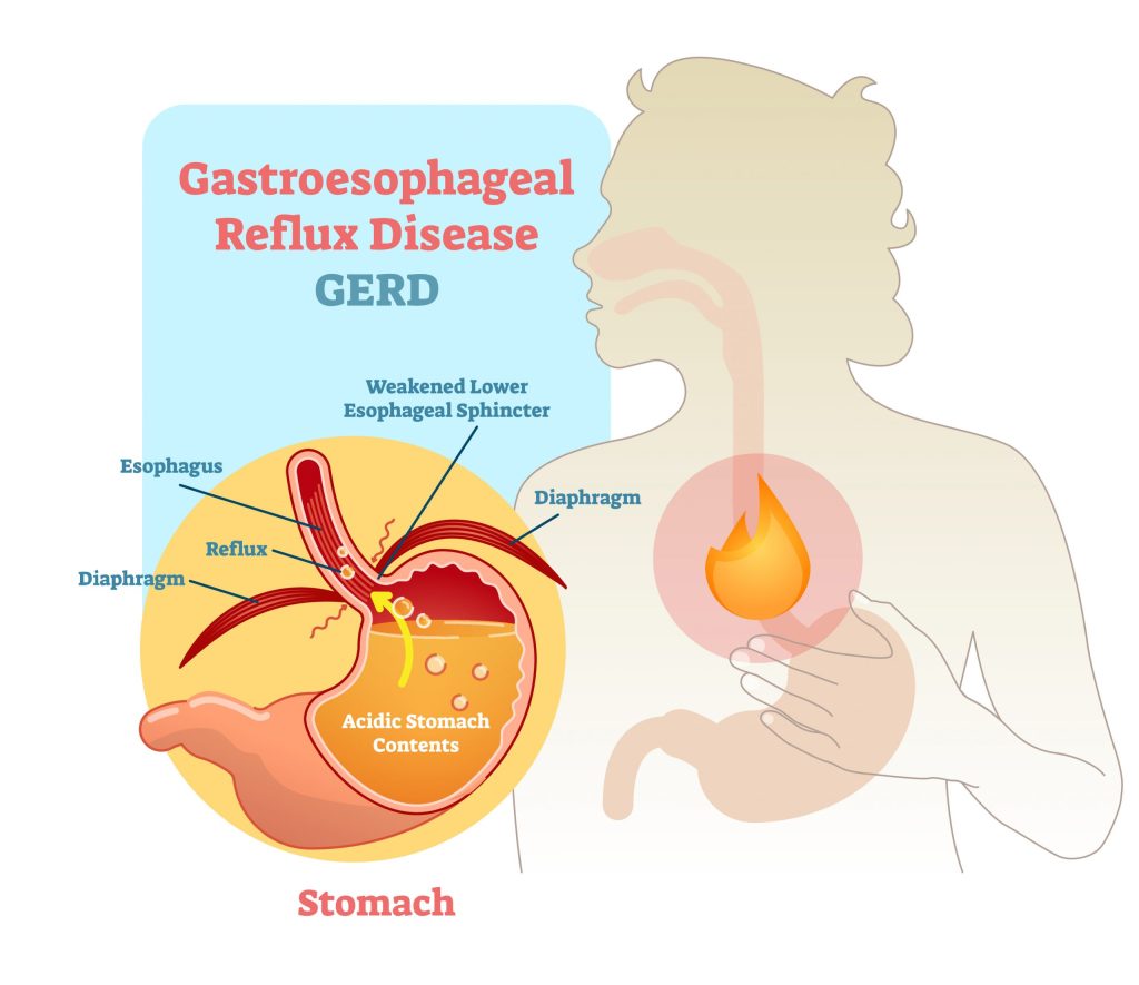 GERD diagram