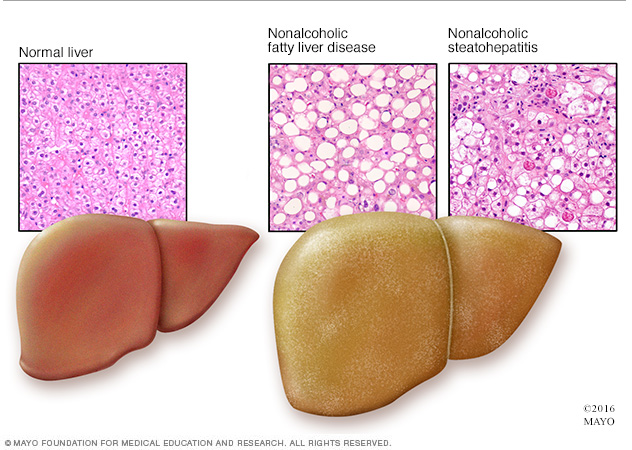 healthy vs non-healthy livers