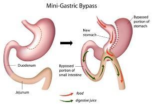 mini-gastric-bypass-diagram