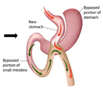 smartshape mini gastric bypass